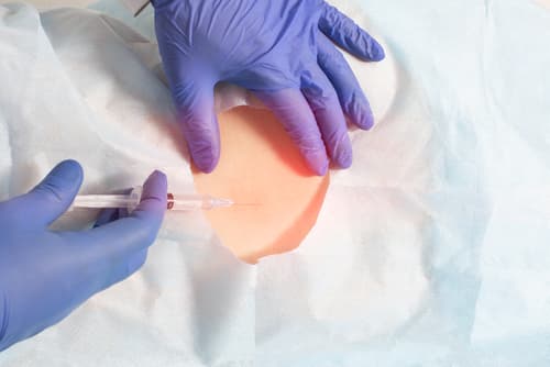 Epidural Steroid Injection