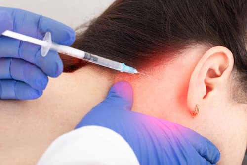 Occipital Nerve Blocks
